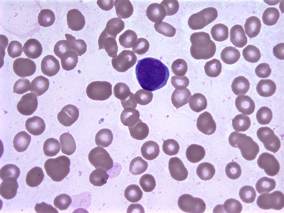 myeloblast, bone marrow aspirate smear